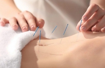 Có nên châm cứu đau thần kinh tọa hay không?